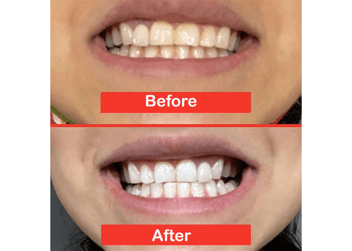 Zimba Teeth Whitening Strips