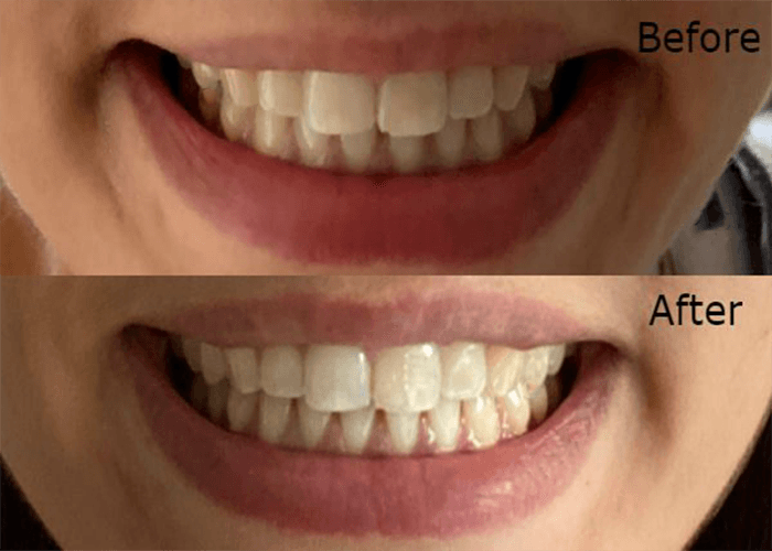 Hismile Teeth Whitening Kit 