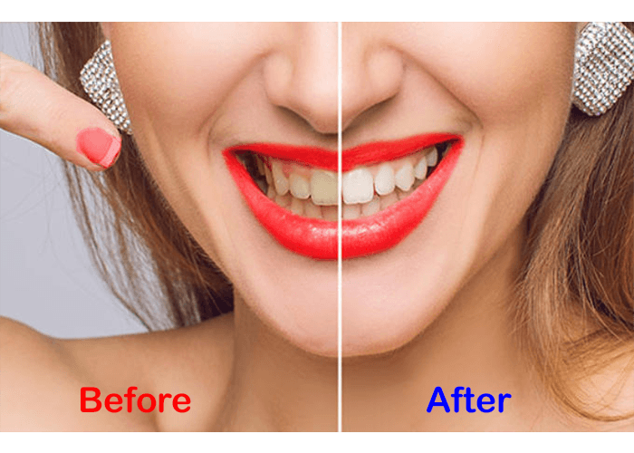 Lumineux Teeth Whitening Strips: before and after