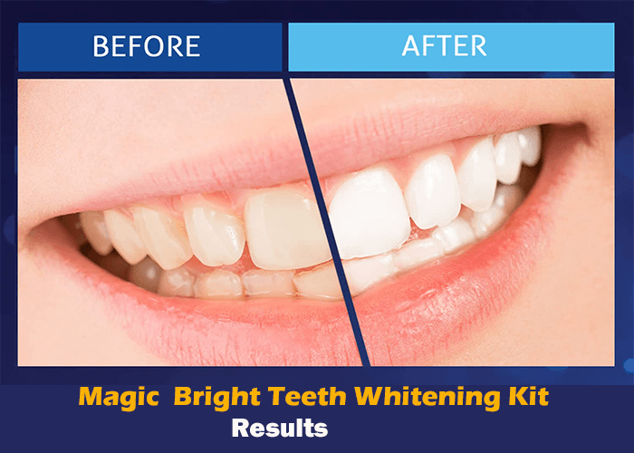 Magic Bright Complete Teeth Whitening Kit