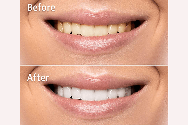 Pankoo Teeth Whitening Strips Review