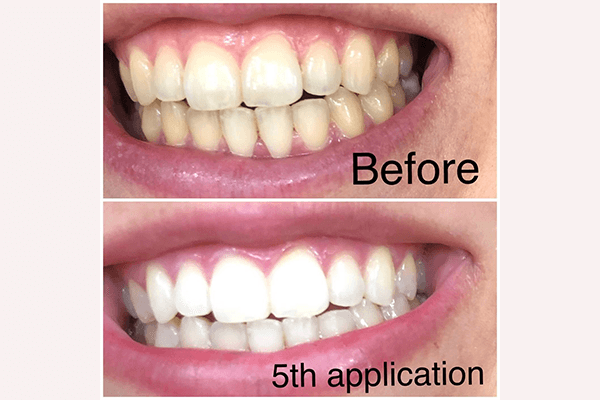 Whitebite Pro Teeth Whitening Kit Review