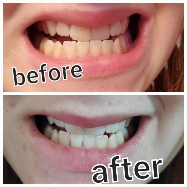 Before and After Using Teeth Whitening Pen