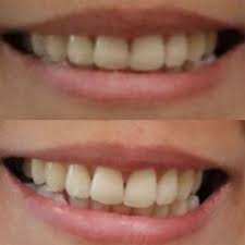 Before and After Using Teeth Whitening Pen