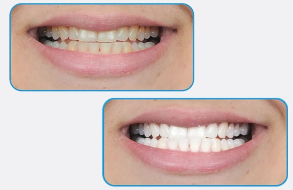 Before and After Using Teeth Whitening Pen