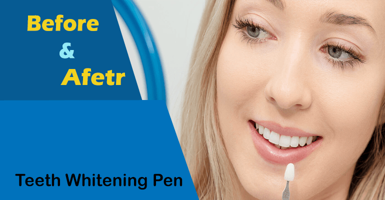 Before and After Using Teeth Whitening Pen: Unveiling The Best Results