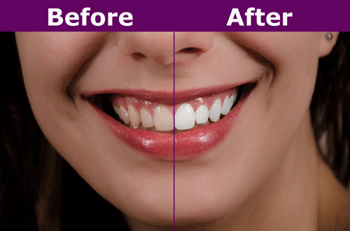 Before and After Using Teeth Whitening Pen