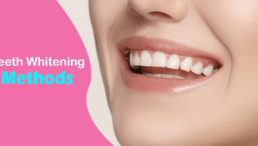 Which Teeth Whitening Methods Should I Choose?