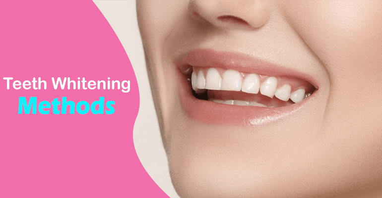 Which Teeth Whitening Methods Should I Choose?