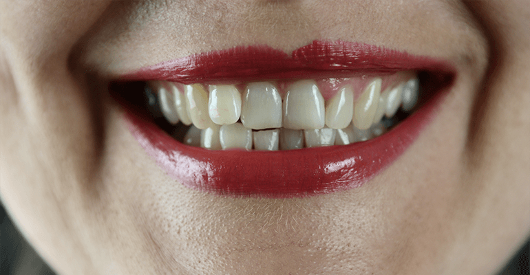 does teeth whitening damage enamel