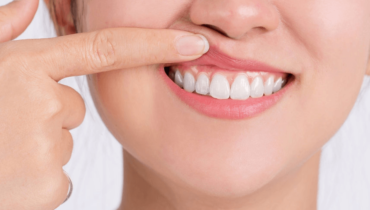 How to Treat Burned Gums from Teeth Whitening? Best Tips and Solutions