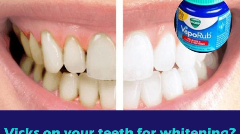 Can you put Vicks on your teeth for whitening?