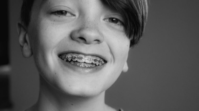 Can you whiten your teeth while wearing braces? Best Suggestions