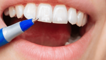 How to get rid of white spots after teeth whitening? Best Tips