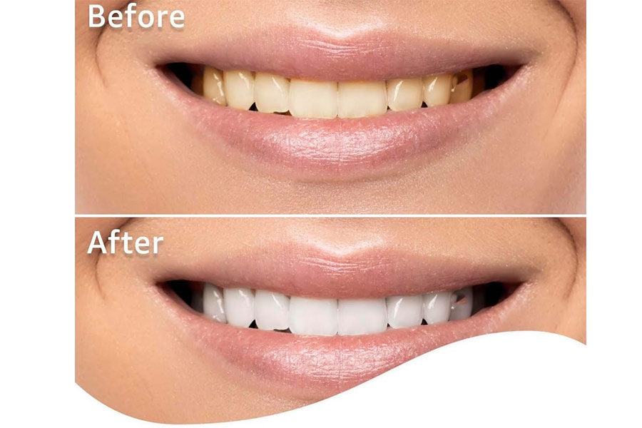 Equate Professional Teeth Whitening Strips Review: before and after