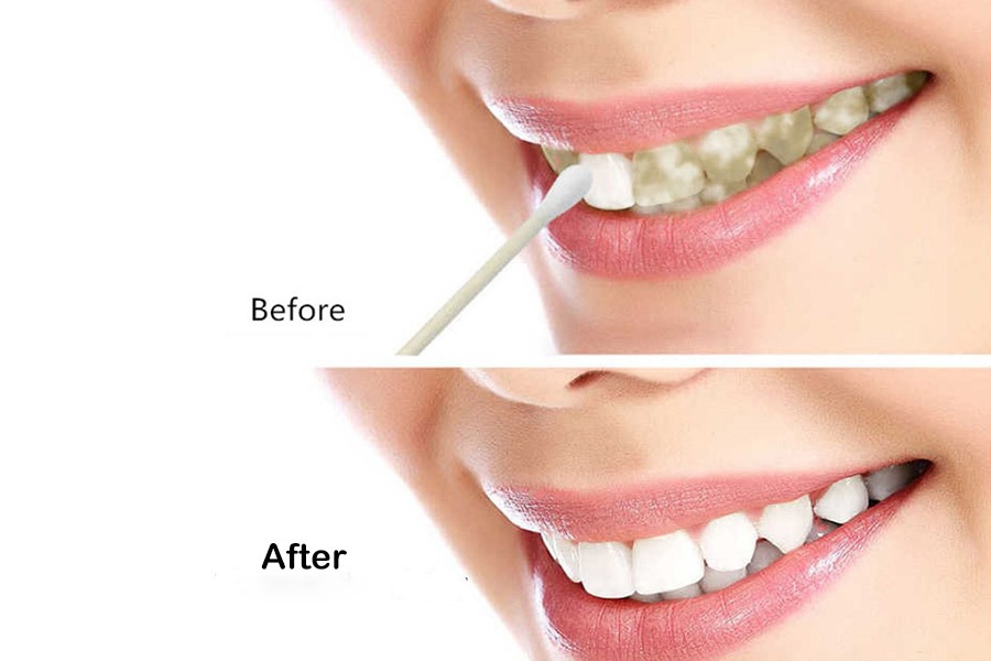 Lanthome White Foam Teeth Whitening Product.