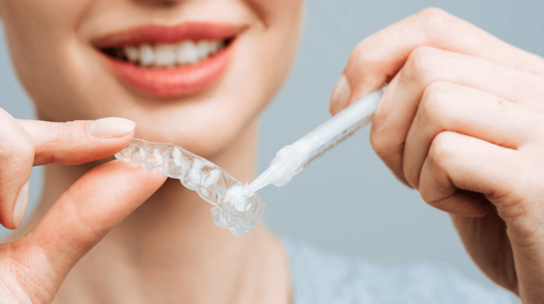 Does teeth-whitening gel expire? Decoding the Shelf Life