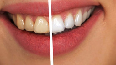 How to Make Your Yellow Teeth White Once More: Reclaiming Confidence