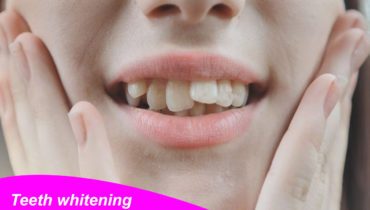 Teeth whitening for crooked teeth: Brighten Your Smile